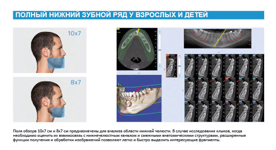ПОЛНЫЙ НИЖНИЙ ЗУБНОЙ РЯД У ВЗРОСЛЫХ И ДЕТЕЙ